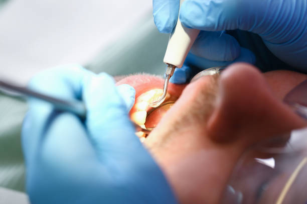 Best Lost Filling or Crown Replacement in Ossun, LA