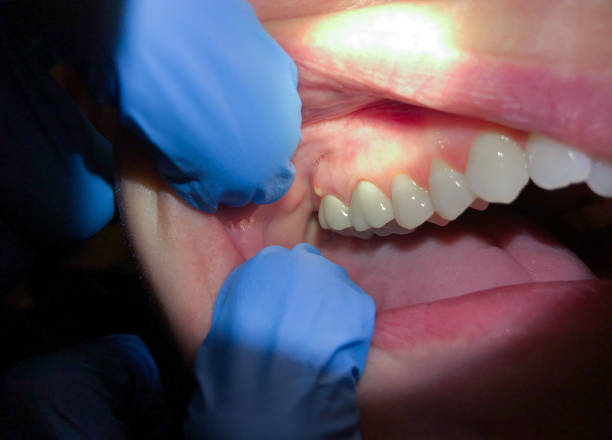 Best Emergency Denture Repair in Ossun, LA
